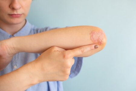 Psoriasis ist nicht ansteckend