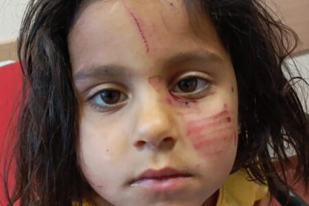 Die 4-jährige Eylül wurde verletzt, als Hunde sie in Şanlıurfa angriffen